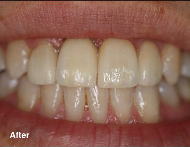 Best Dentist in Mexico Crowns