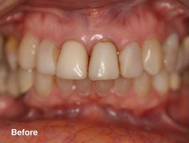 Dental best price in mexico before and after.jpg
