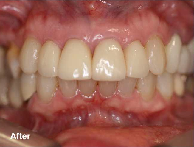 Dental best price in mexico before and after.jpg.jpg2