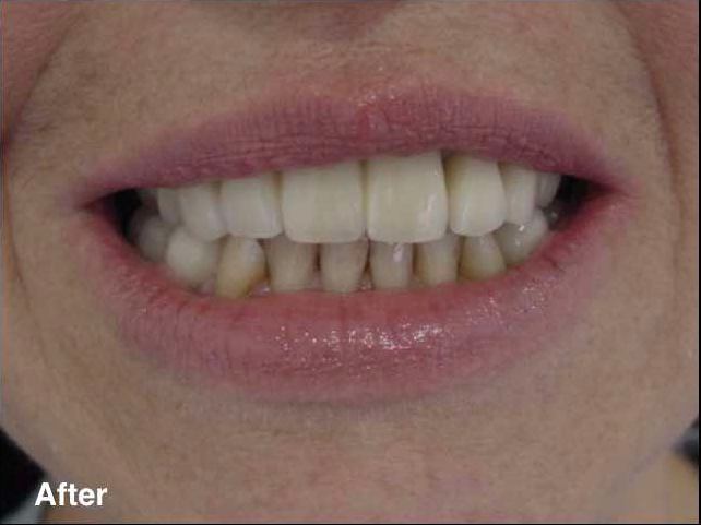 Dental work in mexico before and after