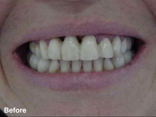 Dental work in mexico before and after.jpg1